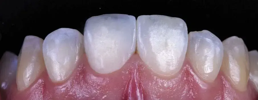 Direct composite restorations