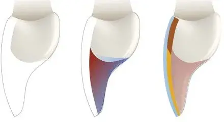 Veneer on severely damaged teeth