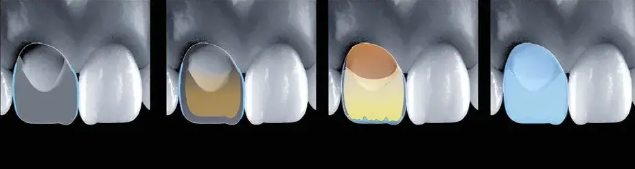 Veneer on severely damaged teeth