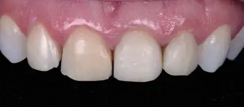 Discolored tooth