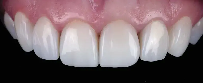 Direct composite restorations