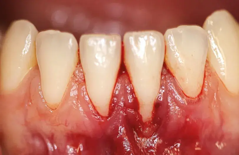 Incision intrasulcular