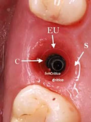 Espacio biologico perimplantario condicionado por el provisional