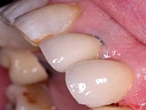 Recesion gingival