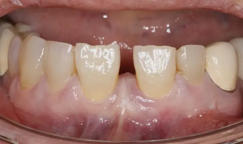 Quiste lateral periodontal