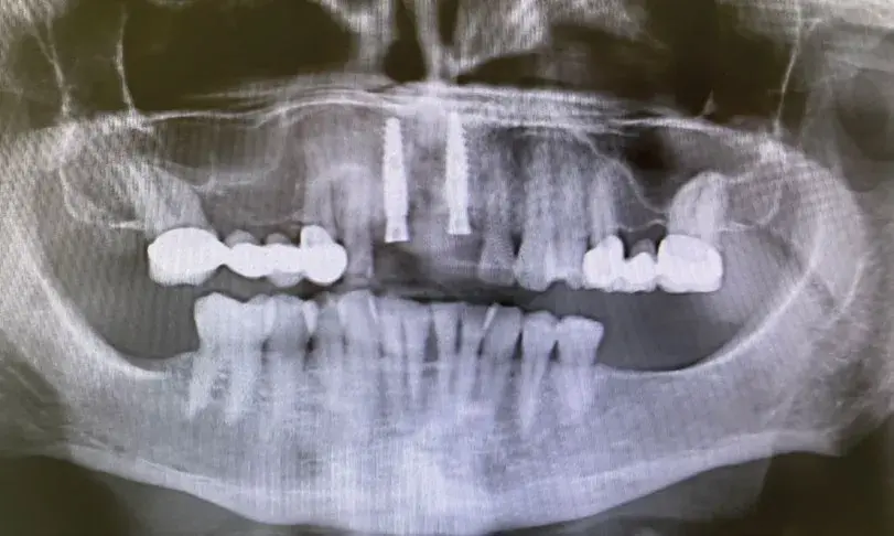 Radiografía una vez colocados los implantes