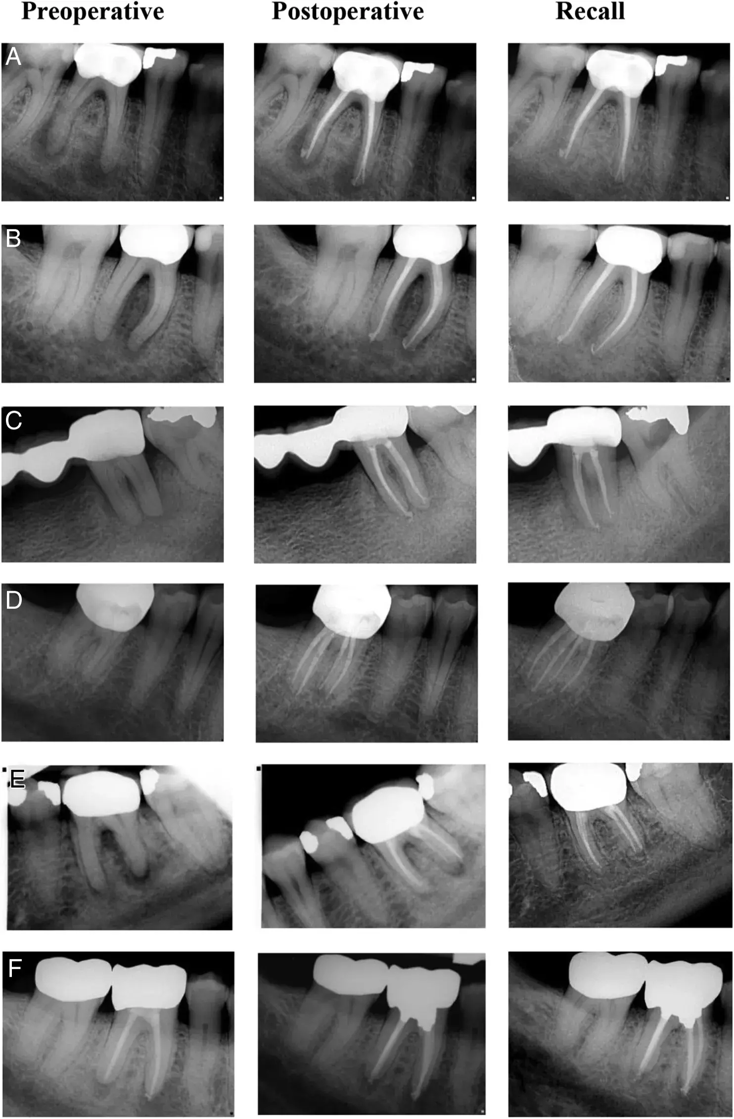 Radiography of periapical lesions