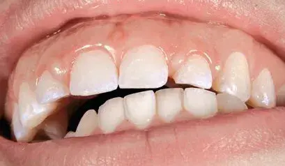 Left lateral occlusal guidance
