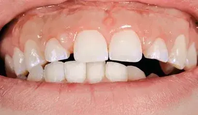 Right lateral occlusal guidance