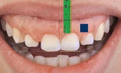 central incisor proportion
