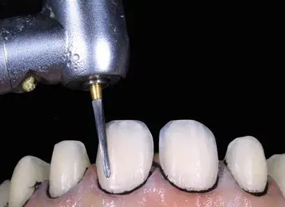 Minimally invasive dental preparation