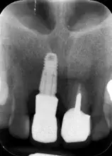 Situazione radiografica iniziale