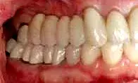 Occlusal contacts