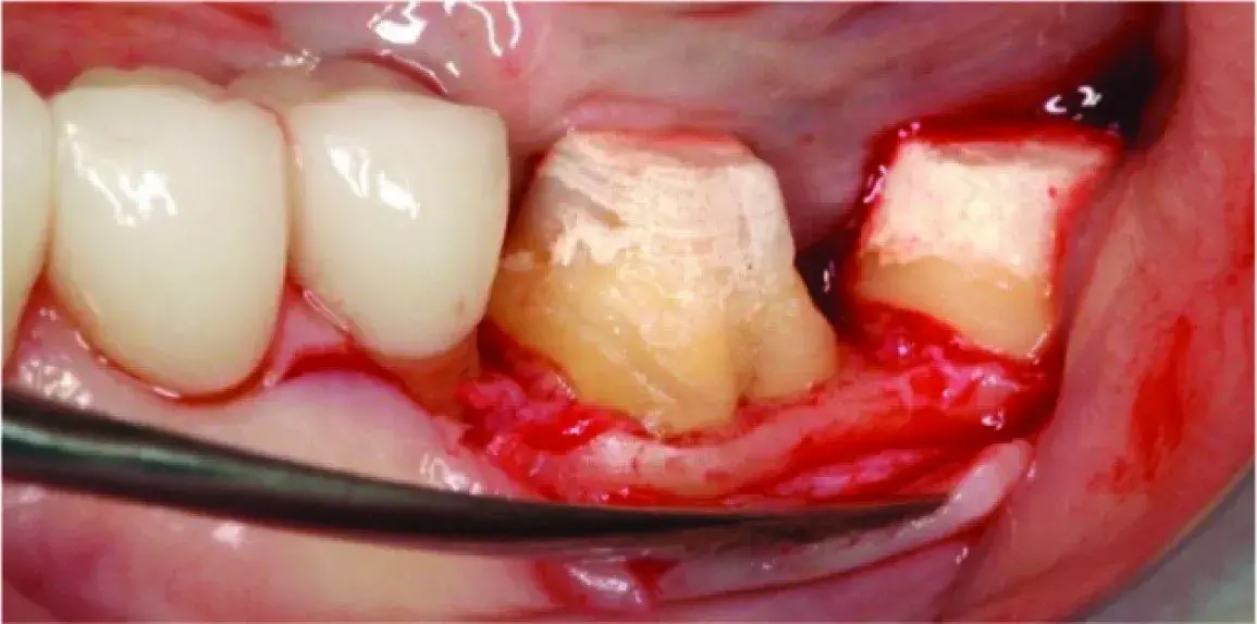 Flap elevation, furcation treatment