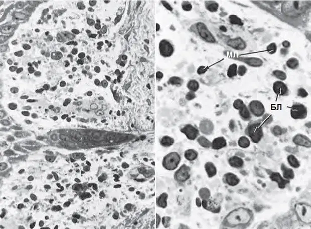 Появление лимфоцитов малого (МЛ) и большого (БЛ) размеров. Светлые пространства вокруг них – отсутствующий коллаген