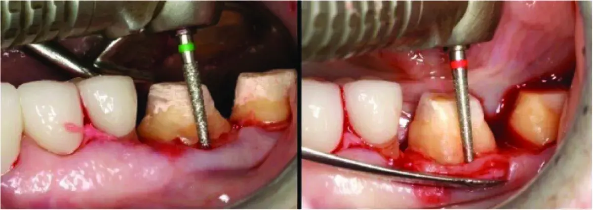 Biologic shaping