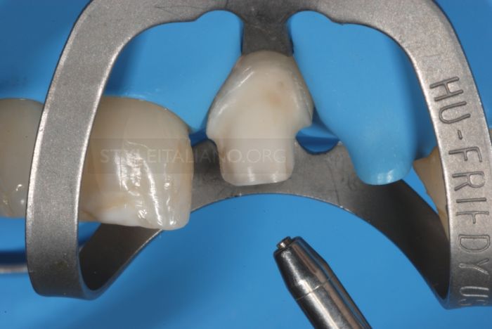 реставрация коронки переднего зуба