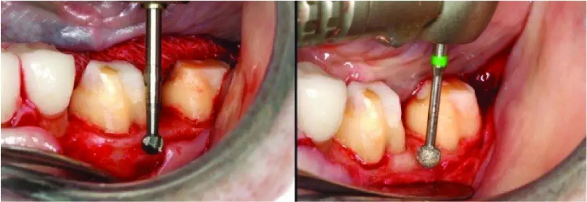 Nonsupporting bone shaping (osteoplasty) 