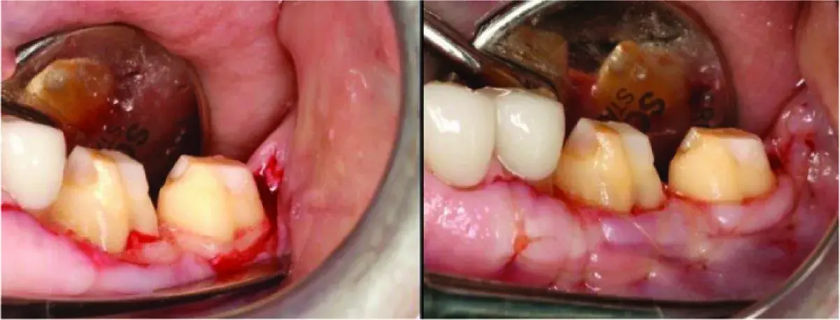 Furcation preparation, flap replacing, suturing