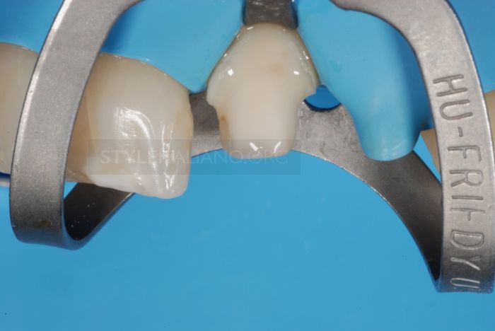 реставрация коронки переднего зуба