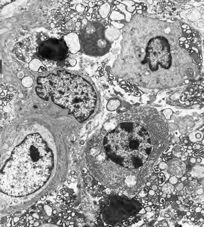 Дегенерация плазматических клеток, клеточные остатки (дебрис)
