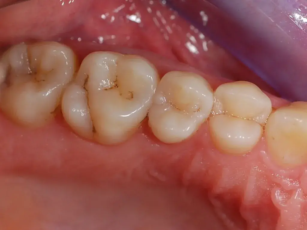 Интактные зубы верхней челюсти