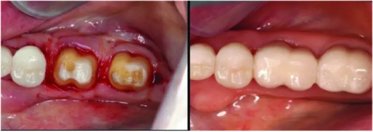 Biologic shaping, interim restoration