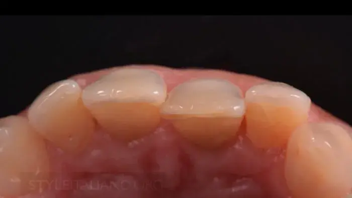 Неправильное смещение зубов будет исправлено с помощью ортодонтической терапии