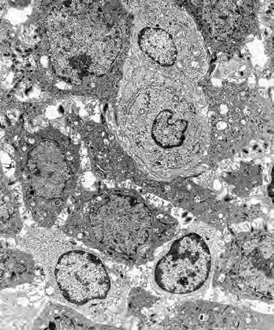 Эпителий десневой борозды с увеличенными межклеточными пространствами, лимфоцитами