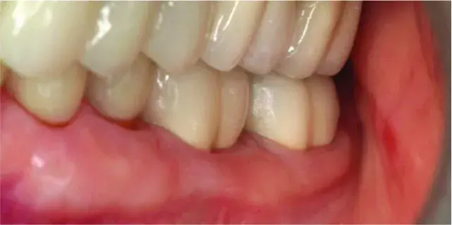 Occlusal contacts after restoration