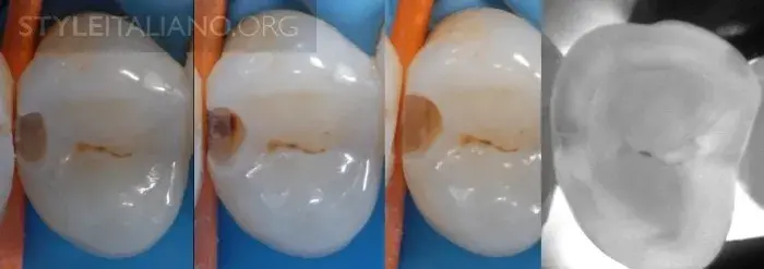 Препарируем полость с максимальным сохранением тканей зуба