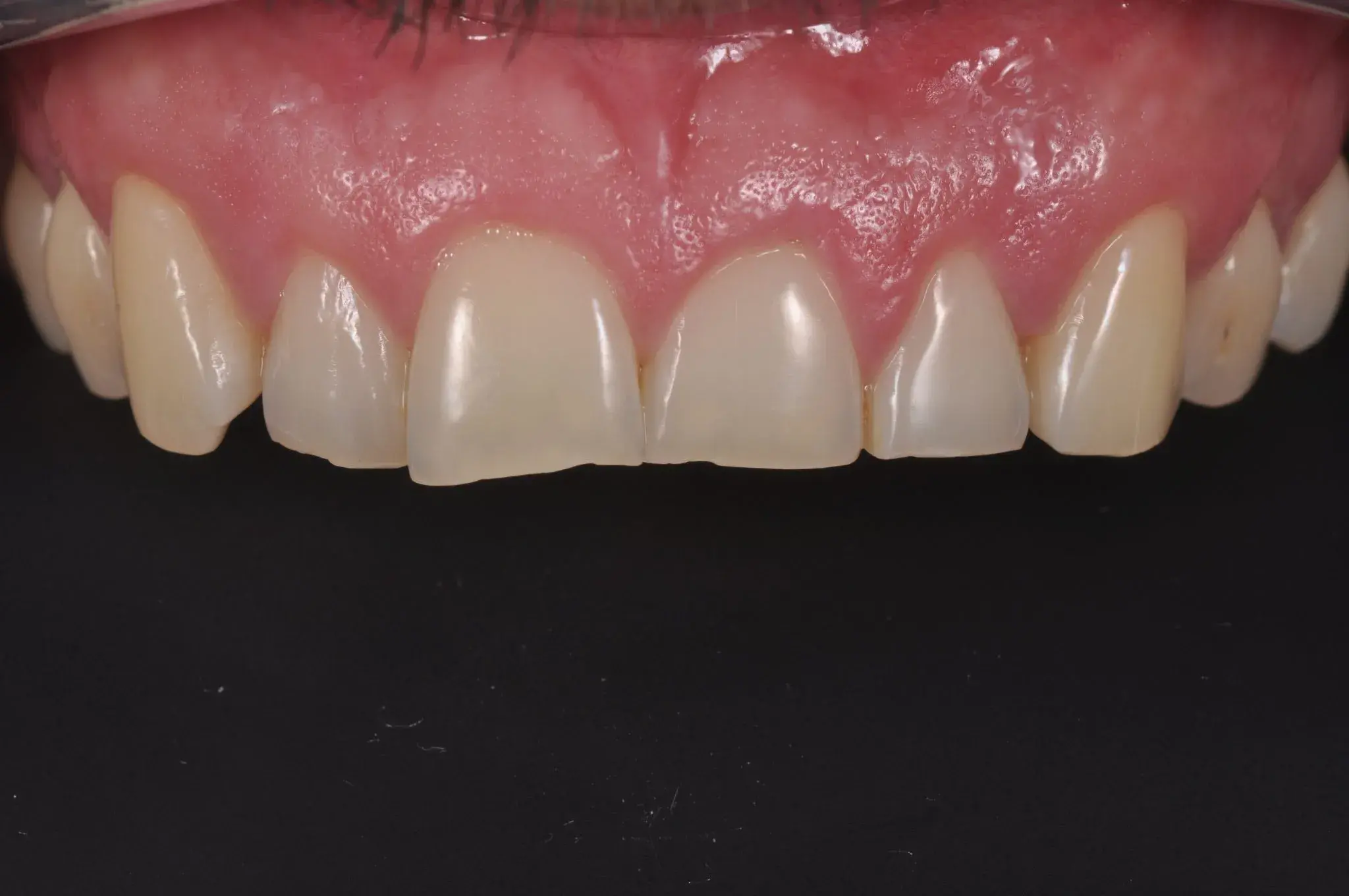 Пришеечная линия асимметрична из-за расположения зубов.