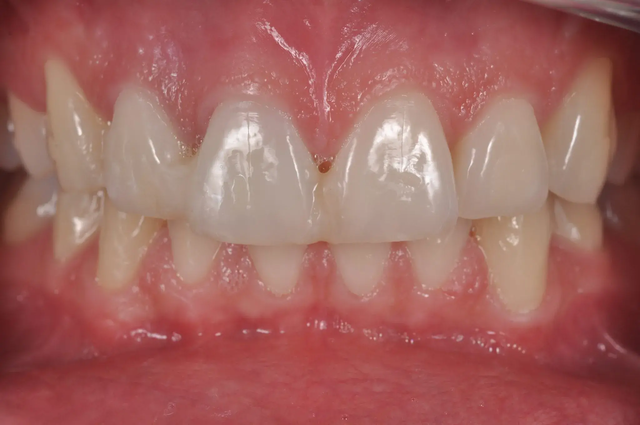 Клинический случай перелом коронок зубов 1.1 и 1.2