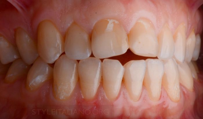 гиперчувствительность зубов