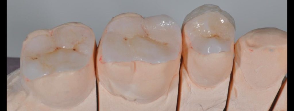 патологическая стираемость зубов фото