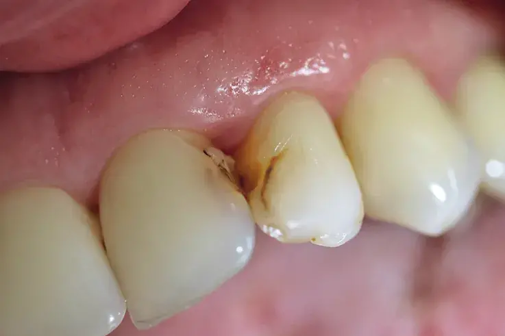 Несостоятельные реставрации на контактных поверхностях зубов 21 и 22