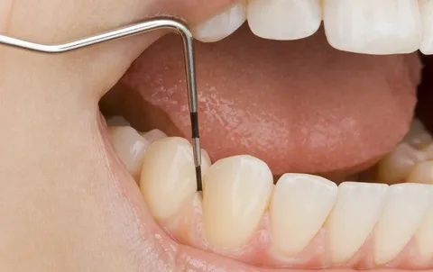 Curettage as a method of gingival surgery