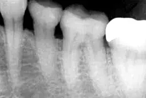 X-ray dental radiography