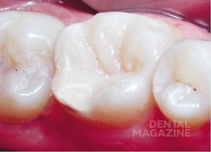 Рис. 33. Внешний вид реставрации зуба 3.6 после этапа шлифовки, полировки.