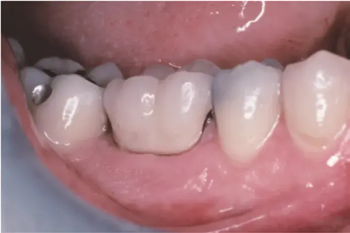 Molar fracture, caries, interim restoration placement