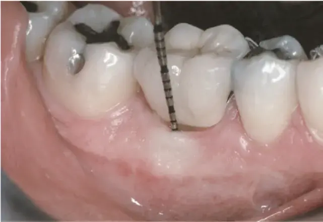 Buccal sulcus depth measurement