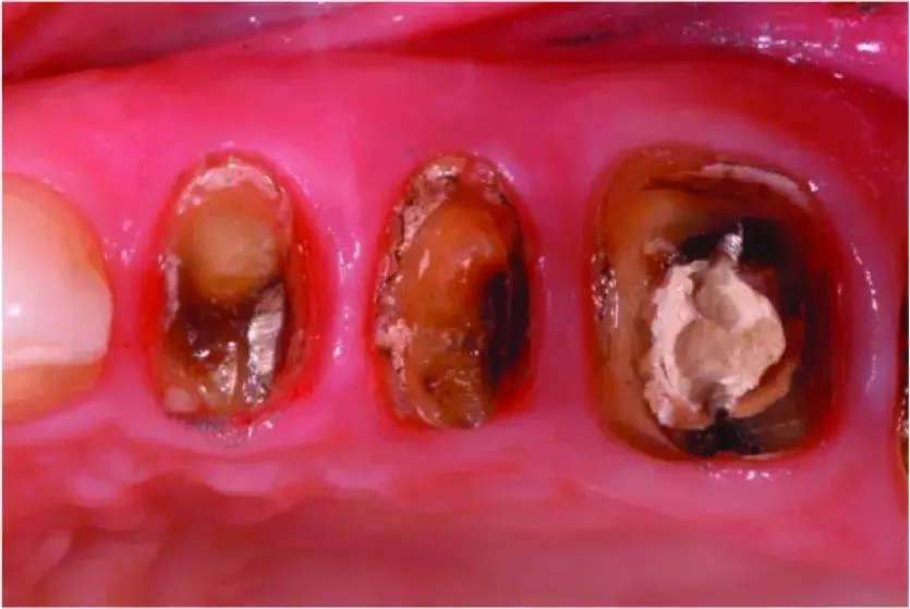 Extensively damaged teeth