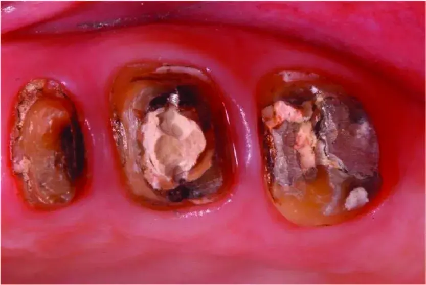 Extensively damaged teeth