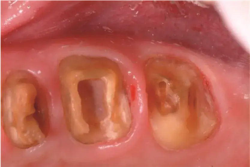 Removal of restorations and caries