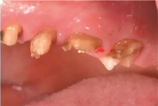 Minimal remaining tooth structure