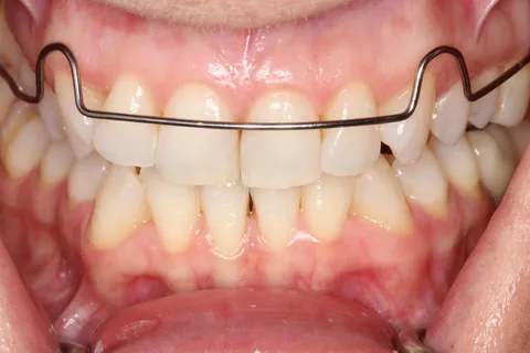 Principios de diseño y características de los elementos de los aparatos de ortodoncia.