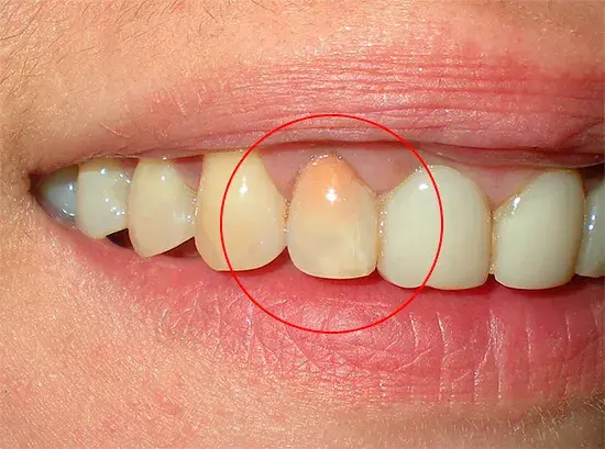 Изменение цвета зуба после лечения резорцин-формалиновой пастой