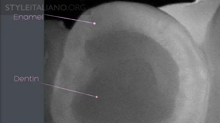 Устройство Diagnocam, в основе которого лазерно-индуцированное просвечивание, позволяет нам просветить жевательные поверхности зубов