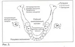 Схема мыщелковых и окклюзионных путей при движении нижней челюсти вправо