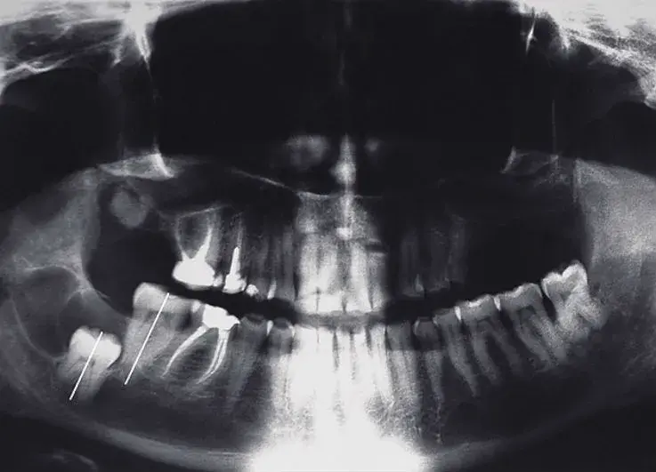 Ретенция 48 зуба, наличие кисты